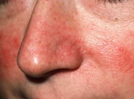 Відня шиї і голови чому з'являється варикоз на обличчі лікування варикозу під язиком і під очима, фото