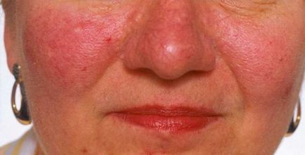 Відня шиї і голови чому з'являється варикоз на обличчі лікування варикозу під язиком і під очима, фото