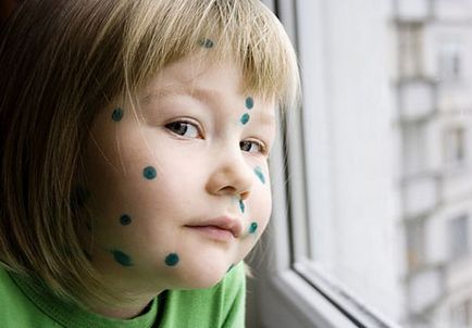 Varicela la copii - simptome, semne, fotografii, tratamentul varicelor la copii