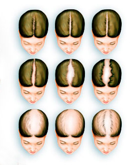Căderea părului în tratamentul și prevenirea femeilor