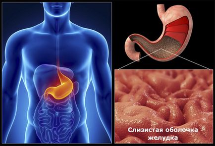 Gyulladása gastritis - tünetek, kezelés, étrend