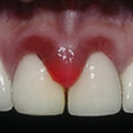 Запалення окістя зуба лікування, причини, симптоми