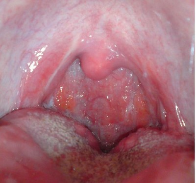 Totul despre faringita atrofică nu este tot ceea ce durează gâtul care doare în gât
