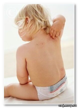 Egészséges életmód (egy egyszerű kontakt dermatitis) egészséges életmód