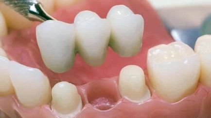 Зуб імплантант скільки коштує імплантація зубів