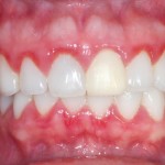 Зуб імплантант скільки коштує імплантація зубів