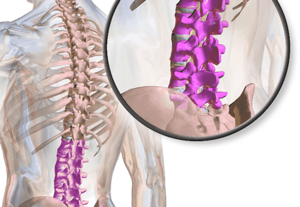 4 Metode de tratament a stenozei spinale