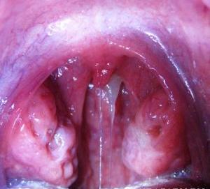 Adenoizii (hipertrofia amigdalelor faringiene) - simptomele și tratamentul remediilor populare la domiciliu