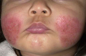 Dermatita alergică alergică, tratament, cum să se distingă dermatita alergică de alte piele