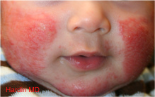 Dermatita alergică alergică, tratament, cum să se distingă dermatita alergică de alte piele