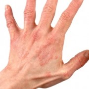 Dermatita alergică în cursul bolii, principalele simptome și terapii