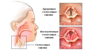 Алергічний ларингіт у дорослих і дітей