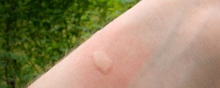 Алергія на комарів у дітей і дорослих основні симптоми алергічної реакції і лікування