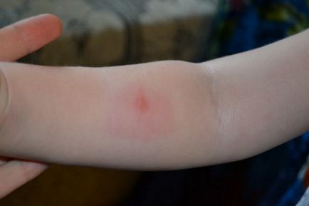 Alergia la țânțarii la copii și adulți reprezintă principalele simptome ale unei reacții alergice și ale unui tratament