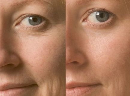 Алмазний пілінг для обличчя фото до і після, протипоказання, відео