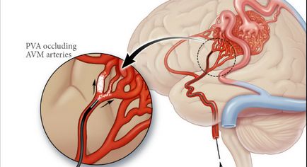 A cerebrovaszkuláris angiográfia (angiogram MPA angioscopy), mint egy diagnosztikai eljárás