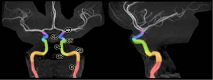 Angiografia vaselor cerebrale (angiogramă, glandă, angioscopie) ca metodă de diagnostic