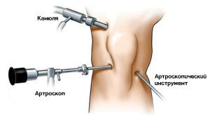 Артроскопія або ендопротезування операція на меніску або протез