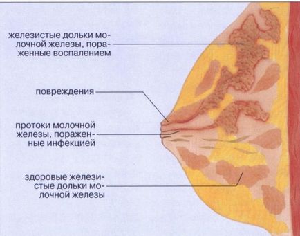 Білі точки на сосках при грудному вигодовуванні закупорка проток та інше