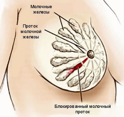 Білі точки на сосках при грудному вигодовуванні закупорка проток та інше