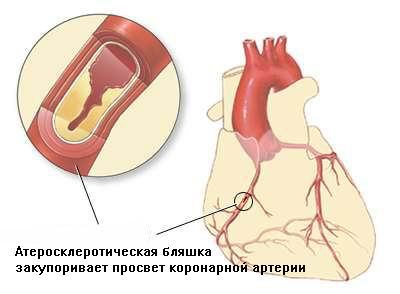 Блокада пучка Гіса причини, симптоми і методи терапії