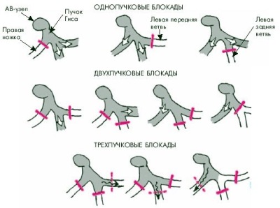 Probleme de blocare a fasciculului de ghips, simptome și metode de terapie