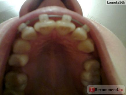 Braces Damon tiszta (átlátszó) - „2 éves merevítők Damon világos, miután 25 év (év) Merevítő Damon tiszta (átlátszó) - „2 éves merevítők Damon egyértelmű 25 év után
