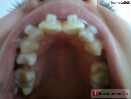 Braces Damon tiszta (átlátszó) - „2 éves merevítők Damon világos, miután 25 év (év) Merevítő Damon tiszta (átlátszó) - „2 éves merevítők Damon egyértelmű 25 év után