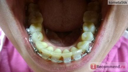 Braces Damon tiszta (átlátszó) - „2 éves merevítők Damon világos, miután 25 év (Damon) Merevítő Damon tiszta (átlátszó) - „2 éves merevítők Damon egyértelmű 25 év után