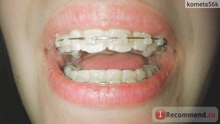 Braces Damon tiszta (átlátszó) - „2 éves merevítők Damon világos, miután 25 év (zárójelek) Merevítő Damon tiszta (átlátszó) - „2 éves merevítők Damon egyértelmű 25 év után