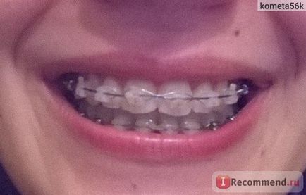 Braces Damon tiszta (átlátszó) - „2 éves merevítők Damon világos, miután 25 év (zárójelek) Merevítő Damon tiszta (átlátszó) - „2 éves merevítők Damon egyértelmű 25 év után