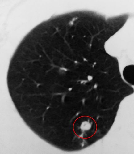 Care este tema tuberculozei? Clasificarea a 5 focare de tuberculoză pulmonară
