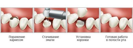 Cirkónium koronák a fogak - az előnyök, funkciók installációk, fotók