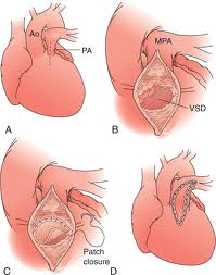 Defectul septului interventricular (dmjp) - un simptom al informațiilor