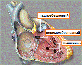 Defectul septului interventricular (dmjp) - un simptom al informațiilor