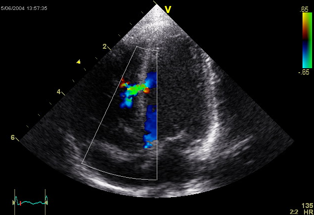 Defectul septului interventricular (dmjp) - un simptom al informațiilor