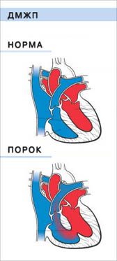 Defecte septul interventricular la adulți