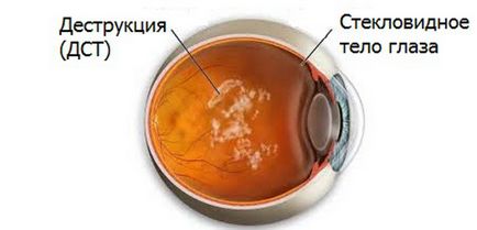 A megsemmisítést a szem üvegtest (DST) - a veszélyes, okai, tünetei és kezelések a mi