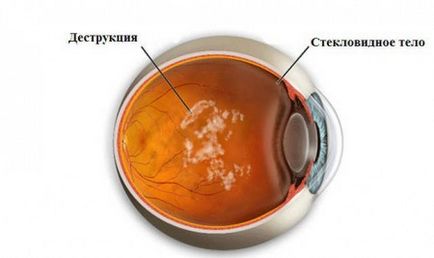 Деструкція склоподібного тіла причини, симптоми, лікування