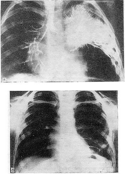 Діагностика аномалій розвитку і захворювань легенів невоспалительного характеру