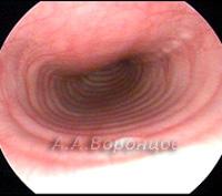 Diagnostic și metode chirurgicale de tratare a colapsului traheal la câini - patologia traheei