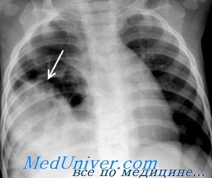 Diagnosticarea leziunilor diafragmei