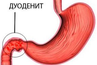 Duodenita ce este, simptomele si tratamentul duodenitei, dieta