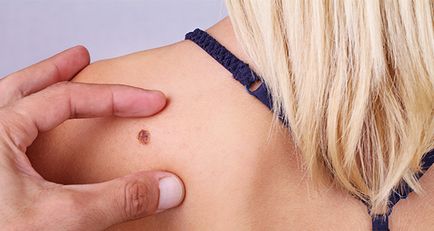 Hatékony kezelés a melanoma orosz a legújabb módszerekkel (kezelési költség melanoma) Hatékony kezelés a legújabb módszerek melanoma orosz