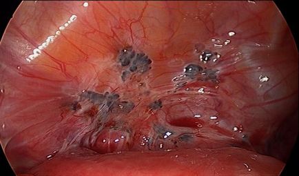 Endometrioza, malysheva credință alexandrovna