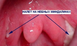 Якщо в горлі білий наліт ніж лікувати, лікування горла