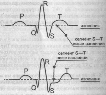 Generarea dinților de bază, intervale și segmente ecg - cardiolog - site despre bolile inimii și vaselor de sânge