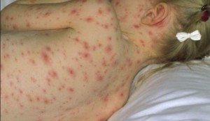 Herpesul pe spatele cauzelor, simptomelor, tratamentului copilului