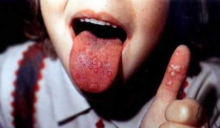 Herpetic stomatitis tratament, cauze și simptome la adulți