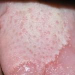 Herpeszes szájgyulladás kezelésére, okai és tünetei felnőtteknél (felnőtt) Herpeszes szájgyulladás kezelésére, okai és tünetei felnőtteknél